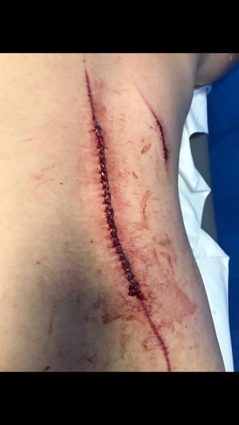 File:Wound pic 3-1.jpg