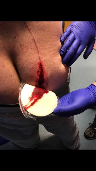 File:Wound pic 1-1.jpg